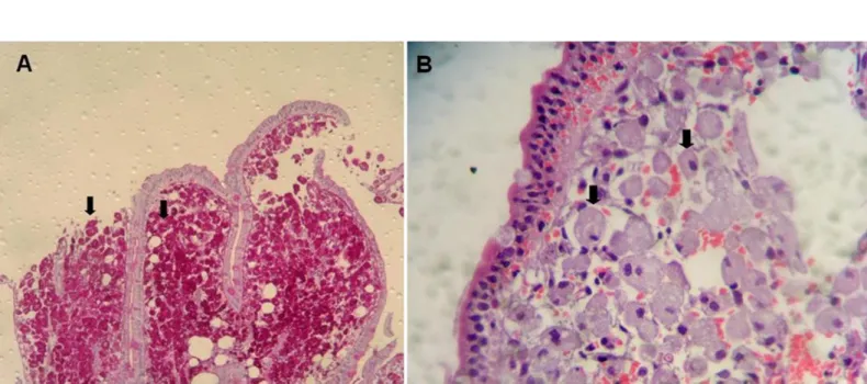 Fig. 1 - (A) Biopsy of the second portion of the duodenum, stained with periodic acid-Schiff (PAS), 10x magnification; and (B) stained with hematoxylin-eosin, 40x magnification, showing  macrophages in the lamina propria.