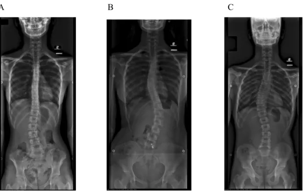 FIGURA 2.8 Radiografias representando os vários tipos de escoliose. (A) Escoliose lombar