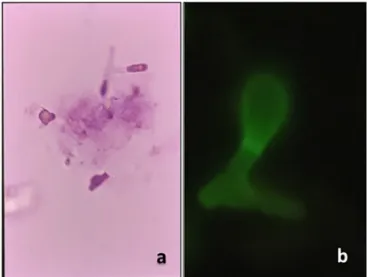 Fig. 1 - Paracoccidioides brasiliensis conidia types. A) Fresh KOH preparations with various  conidia; b) Pedunculated conidium using a fluorescent staining.