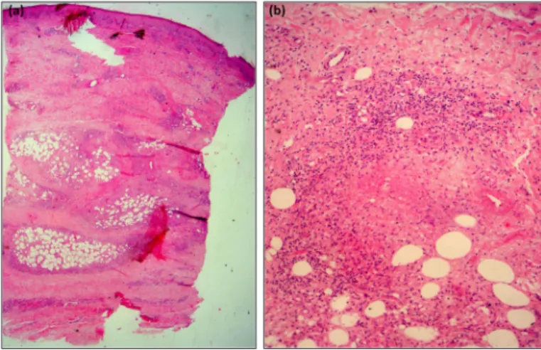 Fig. 2 -  A patient’s histopathological examination showing lobular hypodermitis and  nodular vasculitis