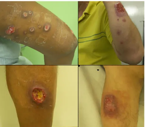 Figure 1 - Sporotrichoid leishmaniasis in upper limbs (upside) and typical cutaneous leishmaniasis in lower limbs (bottom)