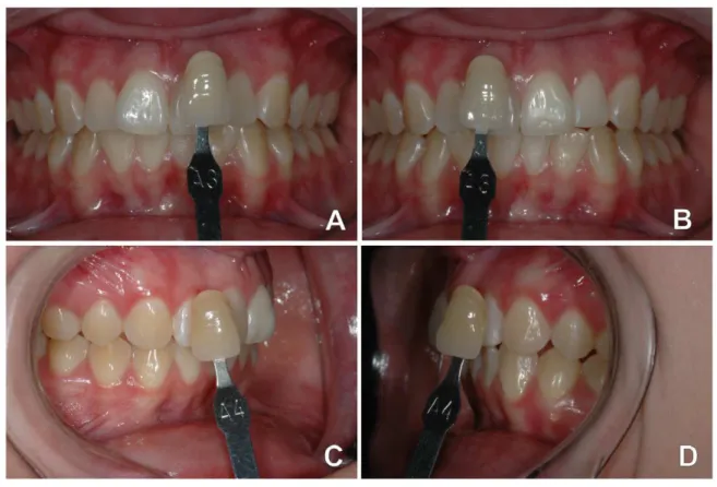 Figura  1- Aspecto  inicial  dos  dentes  a  serem  clareados  (A-  Incisivo  central  superior  direito  de  cor A3,  B-  Incisivo  central superior  esquerdo  de  cor A3,  C-  Canino  superior  direito  de  cor A4,  D-  Canino  superior  esquerdo  de  co