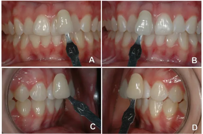 Figura  2- Aspecto  final  dos  dentes  clareados  (A-  Incisivo  central  superior  direito  de  cor  A1,  B-  Incisivo  central  superior esquerdo  de  cor A1,  C-  Canino  superior  direito  de  cor A2,  D-  Canino  superior  esquerdo  de  cor  A2).