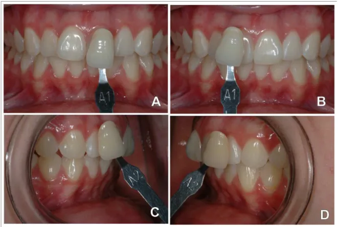 Figura  3- Aspecto  dos  dentes  clareados  30  dias  após  o  término  do  tratamento  (A-  Incisivo  central  superior  direito  de  cor A1,  B- B-Incisivo  central  superior  esquerdo  de  cor  A1,  C-  Canino  superior  direito  de  cor A2,  D-  Canino