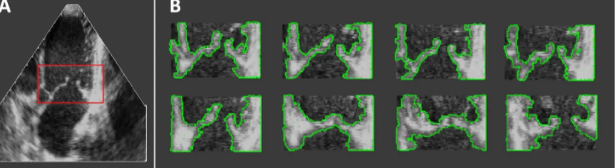 Figure 1.4: A) Original image B) Mitral valve segmentation using region competition based active contour (adapted from [28])