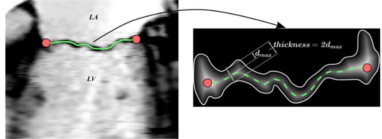 Figure 1.11: Left: Medial axis of the mitral leaflet between a pair of annular points, Right: Estimated thickness (adapted from [46])