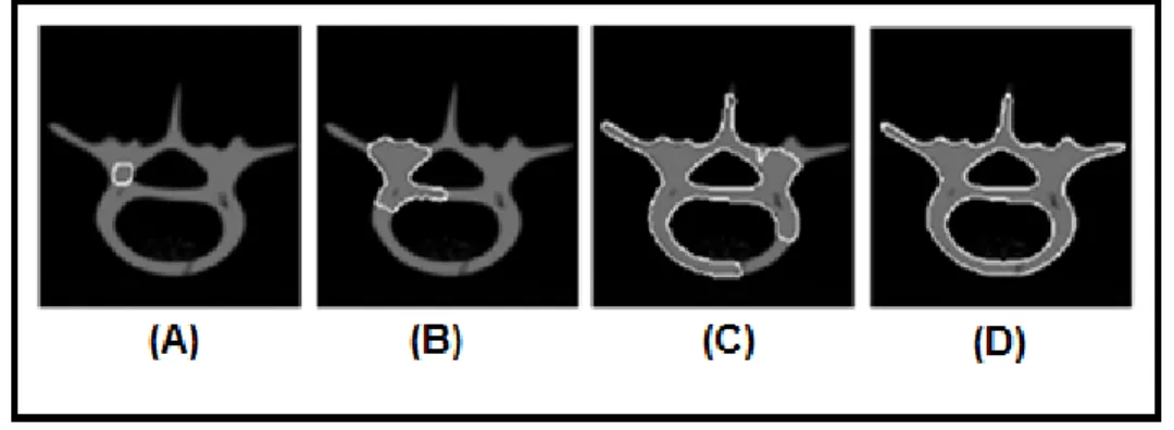 Figure  4.3.  Segmentation  of  a  cross  sectional  image  of  a  human  vertebra  phantom  using  a  topology-adaptable  snake