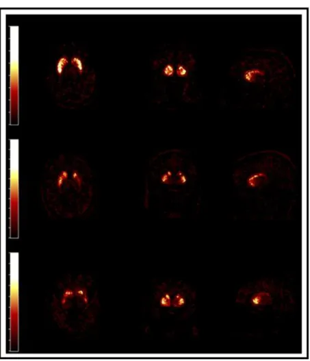 Figure 6.1 Transversal, Coronal and Sagittal views (left-right) of the segmented right striatum of  three HRRT PET images  (top-down), these images  were image provided  by Turku PET Center  visualized using [49]