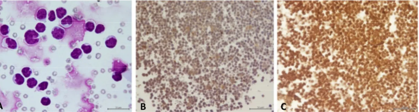 Figura  7  –  Linfoma  mediastínico  T.  A:  preparação  citológica  com  linfócitos  médios  a  grandes  de  núcleos  irregulares; B: a maioria dos linfócitos é negativa para PAX5 (com ligeira marcação inespecífica de fundo); C: 