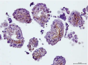 Figura 10 – Efusão carcinomatosa. As células neoplásicas têm marcação para E-caderina nas membranas  basolaterais comprovando a sua origem epitelial