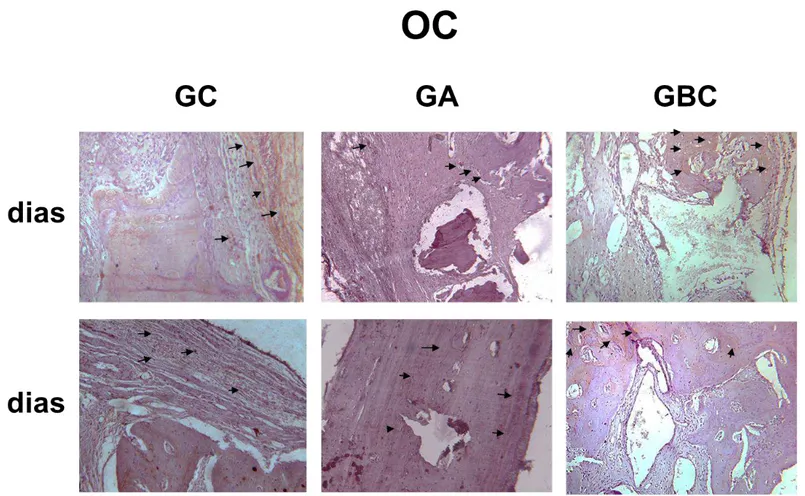 Figura 8  – Imunomarcação de osteocalcina (OC) aos 14 dias para os grupos experimentais (GC: leve; GA: moderada; GBC: moderada)