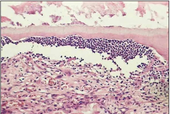 Fig. 2 – Grupo I (hidróxido de cálcio) – Área de reabsorção inflamatória com presença  de numerosos linfócitos