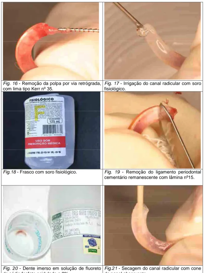 Fig. 16 - Remoção da polpa por via retrógrada,  com lima tipo Kerr nº 35. 