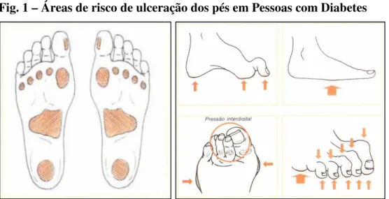 Fig. 1 – Áreas de risco de ulceração dos pés em Pessoas com Diabetes