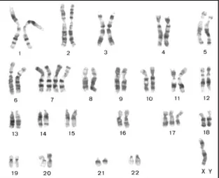 Figura 3 – Exemplo de um adenoma de células renais do tipo papilar com tetrassomia 7, trissomia 17 e  perda do cromossoma Y (Kovacs et al., 1989)