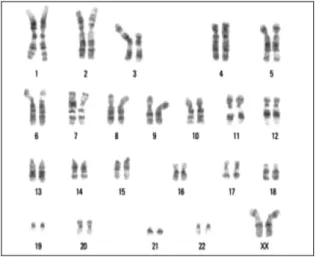Figura 5 – Exemplo de um cariótipo de carcinoma de células claras com deleção de 3p (Grignon et al.,  2004)