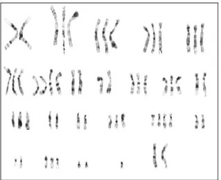 Figura 6 – Exemplo e um carcinoma de células renais papilar com múltiplos ganhos cromossómicos  (Soller et al., 2007)
