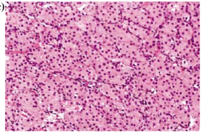 Figura 10 – Morfologia de carcinoma cromófobo (a), variante eosinofílica do carcinoma cromófobo (b) e  oncocitoma (c)