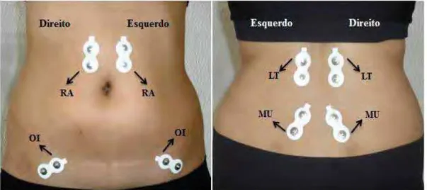 Figura 2 - Localização dos músculos do tronco. Legenda: Reto Abdominal (RA),  Obliquo Interno (OI), Longuíssimo do Tórax (LT), Multifido (MU)