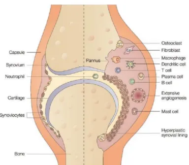 Figure 2. Schematic comparison between a normal joint (left) and a joint affected by RA (right)