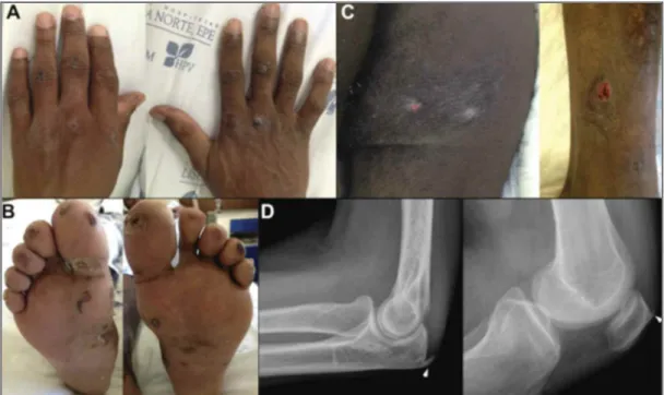 FIGurE 1.  Hyperpigmented papules on the extensor surfaces of the metacarpophalangeal and proximal interphalangeal joints (A) and purpuric lesions on the soles (B)