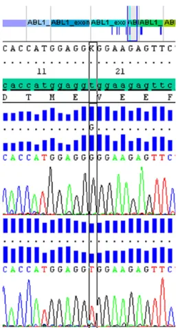Figure 1.  BCR-ABL tyrosine kinase domain mutation analysis in  peripheral blood revealed c.839T&gt;G (V280G mutation), in which  GTG→GGG (valine to glycine).
