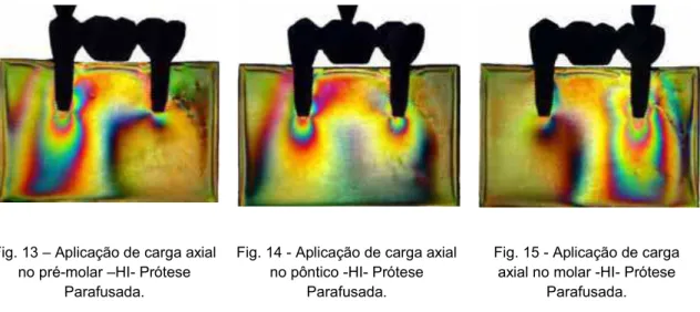 Fig. 13 – Aplicação de carga axial  no pré-molar –HI- Prótese 
