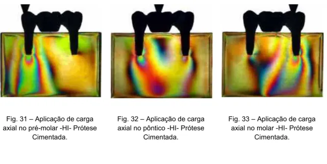 Fig. 30 – Aplicação de carga  oblíqua no molar -HE- Prótese 