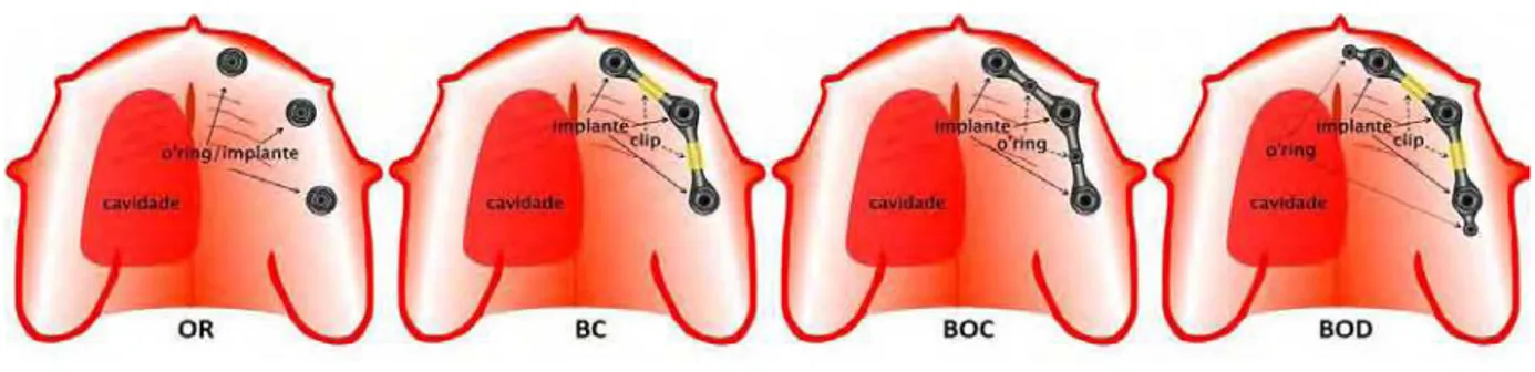 Figura 1: Esquema dos sistemas de retenção em implantes utilizados neste estudo 