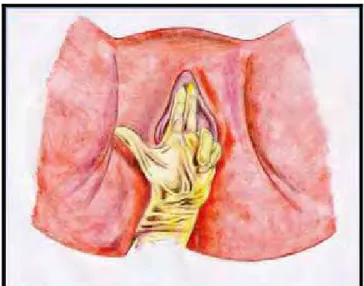 Figura 2. Ilustração da avaliação do AP pela palpação bidigital da vagina.  