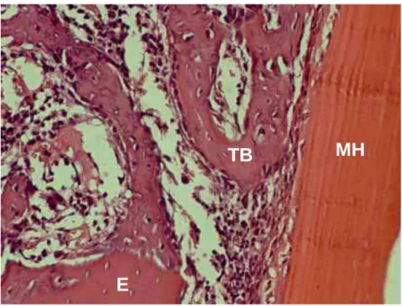 Figura 3 – ICMH10 – A membrana homógena (MH) recobre a  cavidade e o enxerto ósseo (E) esta sendo incorporado por  meio de trabéculas ósseas delgadas