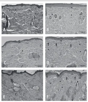 Figure  4.  A)  Shows  the  histological  sections  from  the  group  III  sample,  which  did  not  receive  LS  irradiation