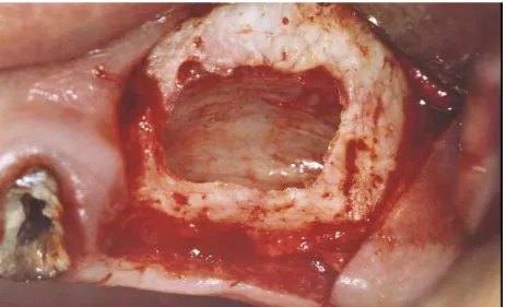 Figura 4 – Região do seio maxilar, após o deslocamento  superior  da  mucosa  sinusal  criando  espaço  para  interposição de enxerto ósseo