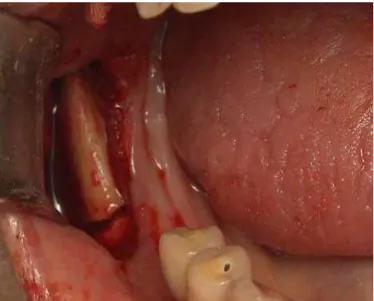 Figura  7  –  Vista  da  região  retromolar    após  incisão,  descolamento  do  retalho  muco-periostal  e  osteotomia  da porção vestibular do ramo mandibular