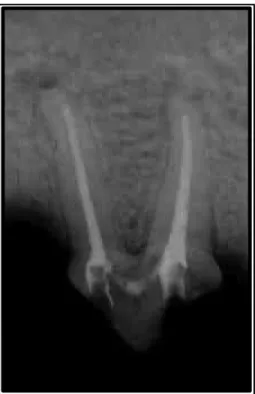 Figura 2: Imagem radiográfica de segundo pré-molar superior de cão, aos 120 dias,  tratado com Guta-percha e óxido de zinco e eugenol evidenciando canal  radicular totalmente obturado e presença de imagem radioluscente ao redor dos  ápices radiculares