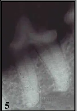 Figura 5: Imagem radiográfica de terceiro pré-molar inferior de cão, aos 120 dias, do  grupo sem tratamento, sem alterações