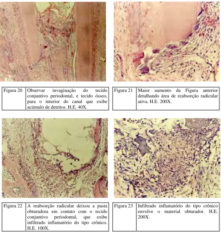 Figura 20  Observar  invaginação  do  tecido  conjuntivo  periodontal,  e  tecido  ósseo,  para  o  interior  do  canal  que  exibe  acúmulo de detritos