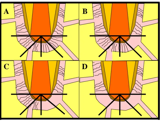 FIGURA 16 -  Representação esquemática da inserção do ligamento periodontal do  cemento ao tecido ósseo em toda porção apical (A), em 3/4 da porção  apical (B), em 2/4 da porção apical (C) e ausência de organização na  porção apical (D)