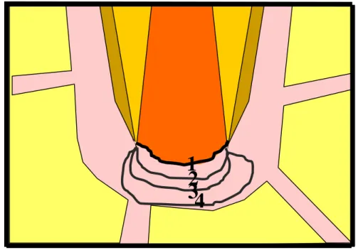 FIGURA 17-  Representação esquemática da extensão do infiltrado  inflamatório: ausente (1); restrito às proximidades do  cemento neoformado ou luz do canal radicular (2); invade  até metade do espaço do ligamento periodontal (3); invade  todo o espaço do l