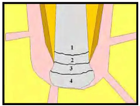 FIGURA 18 - Representação esquemática dos escores atribuídos  aos vários limites apicais passíveis de serem  atingidos pelo material obturador.