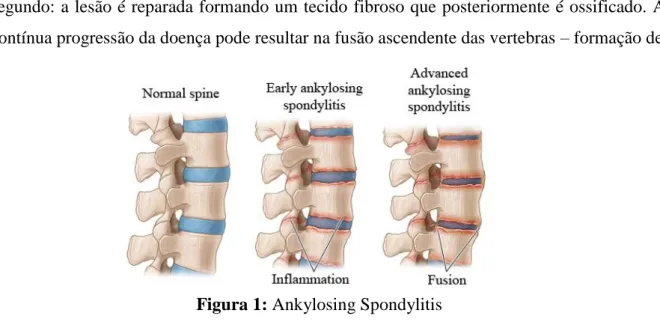 Figura 1: Ankylosing Spondylitis 