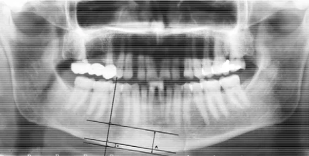 Figura  6-  Índice  mandibular  panorâmico  (PMI,  do  inglês  “panoramic  mandibular  index”)