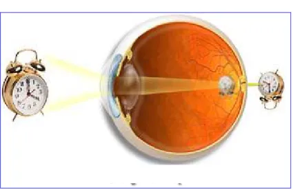 Figura 7: Olho com Hipermetropia (Amétrope)  