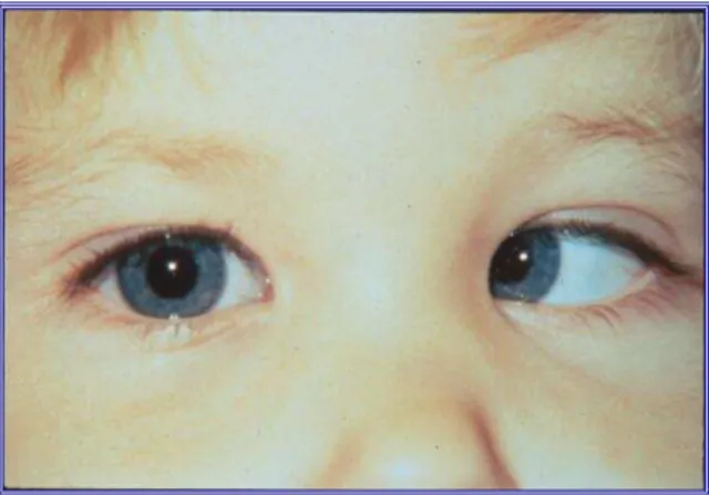 Figura 10: Esotropia do Olho Esquerdo 