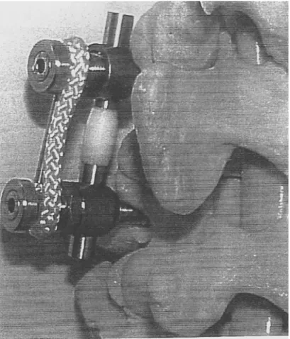 Fig. II.3.2-1 -Sistema “FASS” aplicado em modelo artificial - Mulholand et al (2002) (106) 