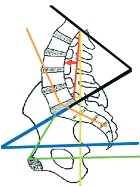 Fig. I.2.4-1 -Determinação dos diferentes ângulos e medições lombo sagradas. Azul (ângulo de inclinação  sagrada), Preto (medição angular da lordose lombar ),Laranja (ângulo lombo-sagrado), Verde (ângulo da 