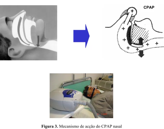 Figura 3. Mecanismo de acção do CPAP nasal 