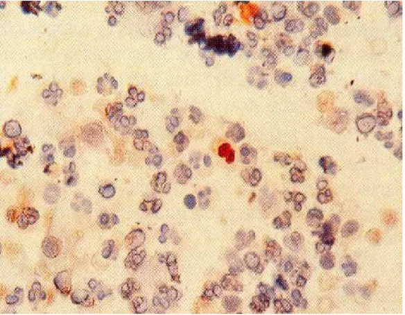 Figura 2: Técnica de antigenémia por imunoperoxidase, observando-se no centro o núcleo  de um leucócito infectado de cor acastanhada