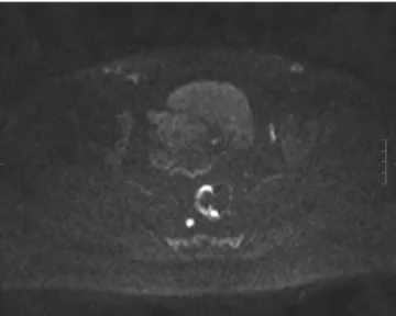 Figure 3 After chemoradiation axial diffusion-weighted shows hyperintensity of the node and rectal wall involved by tumor.