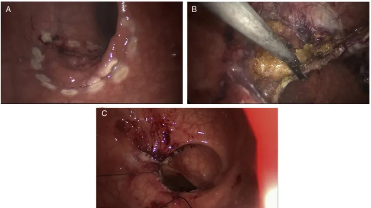 Figure 4 TEM resection of a neoplastic lesion (T1N0) located 20 cm from the anal verge